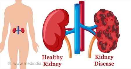 Renal CT scan imaging Renin Superspeciality Hospital